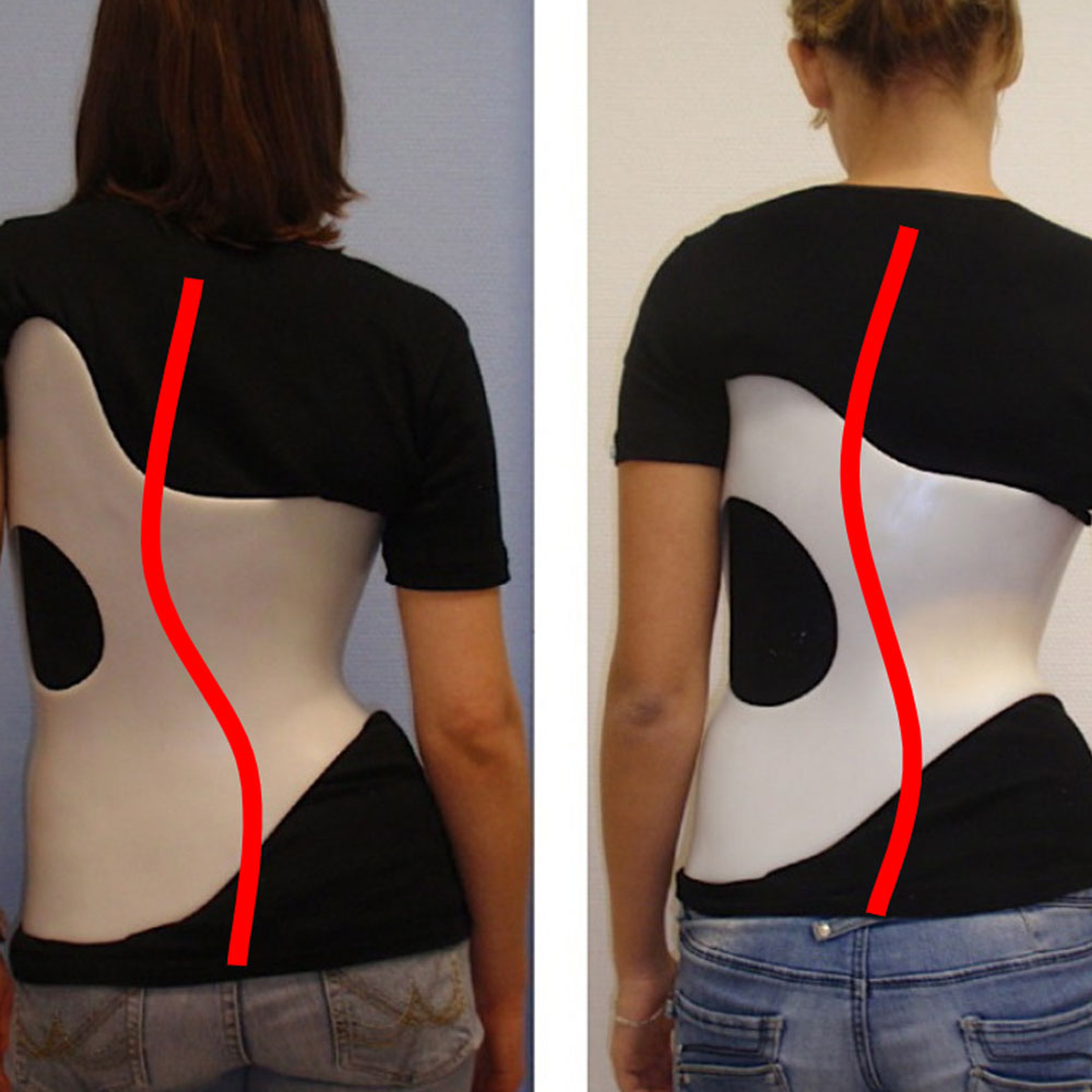 scoliosisback scoliosisback